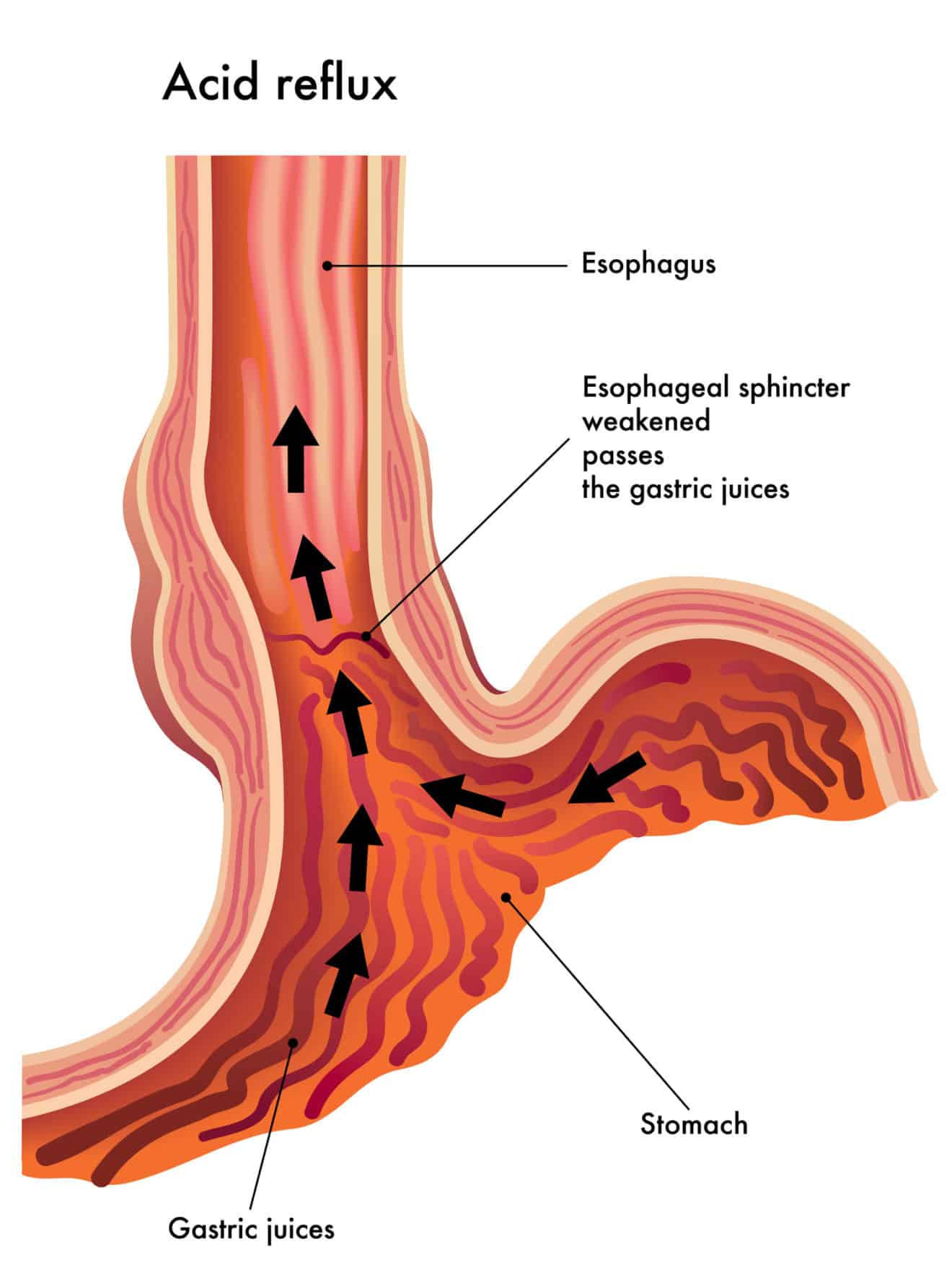 Reflux gastro œsophagien causes symptômes et traitements